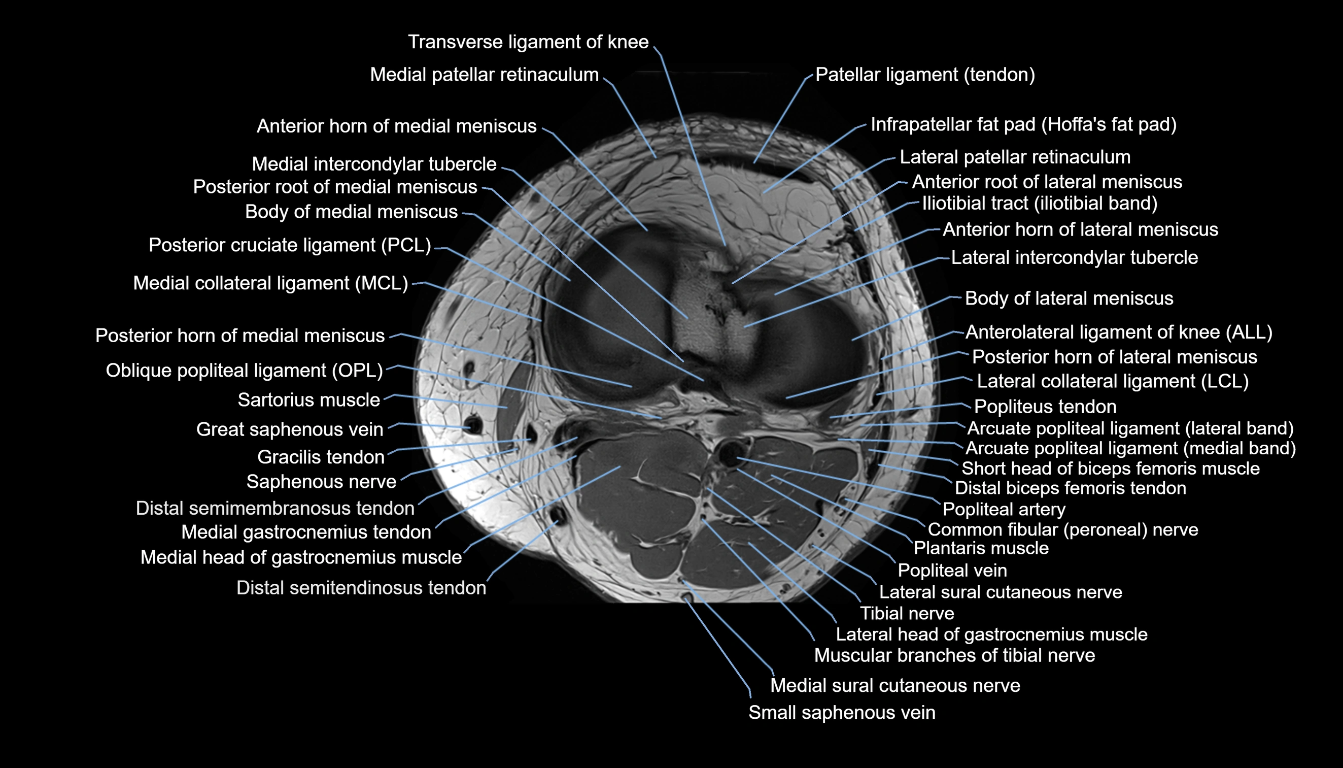 MRI knee  axial cross sectional anatomy 3T radiology  image-img-00001-00030.webp